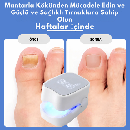 Tırnak Mantarı Lazer Tedavi Cihazı