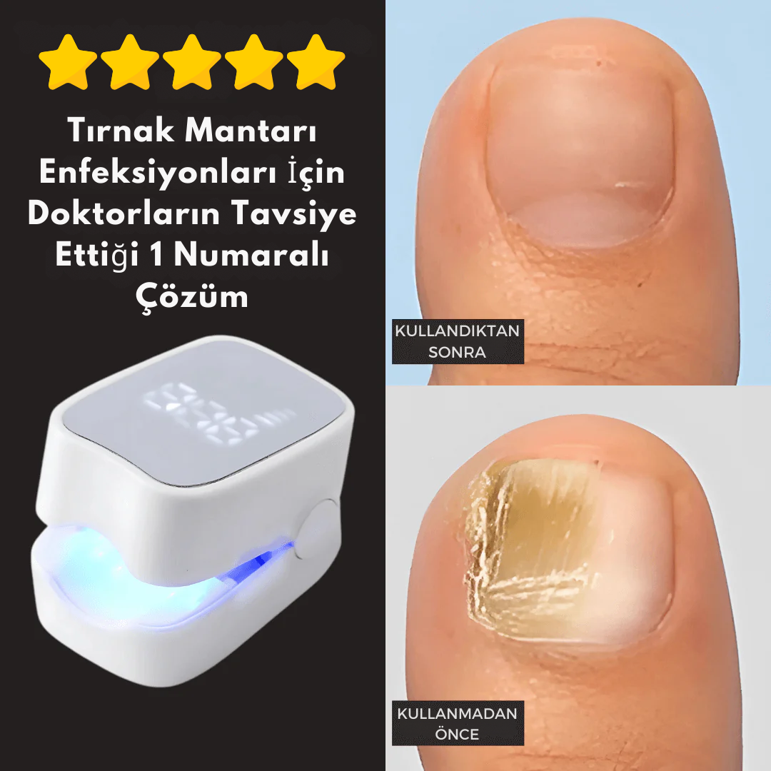 Tırnak Mantarı Lazer Tedavi Cihazı